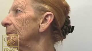 anti aging cream  worlds best fast acting anti aging wrinkle cream demonstration [upl. by Ycrep808]