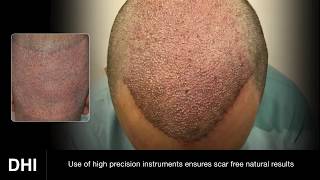 DHI vs FUE  Difference between DHI Technique and FUE [upl. by Kuhlman664]