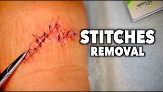 REMOVING 13 STITCHES From a Huge Leg Wound  Dr Paul [upl. by Blondell879]