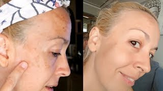 ELIMINAR las MANCHAS o paños de la piel  MELASMA [upl. by Brianna]